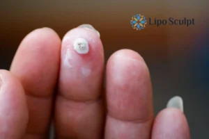 Cryopen Top 5 Treatable Conditions 4 Do you have a persistent wart of verruca that you cannot shit? Cryopen Cambourne treatment will work call us NOW!
