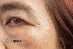 Cryopen: The Revolutionary Treatment for Age Spots Unveiled 2 Are age spots Cambourne giving you low self esteem? Contact us today!