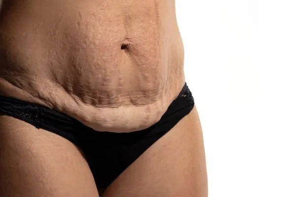 Lost the Weight but Not the Loose Skin? 1 image of womans stomach after weight loss showing loose skin Cambourne